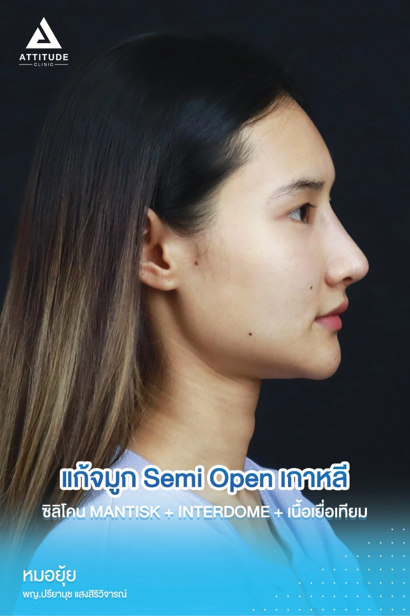 เสริมจมูก