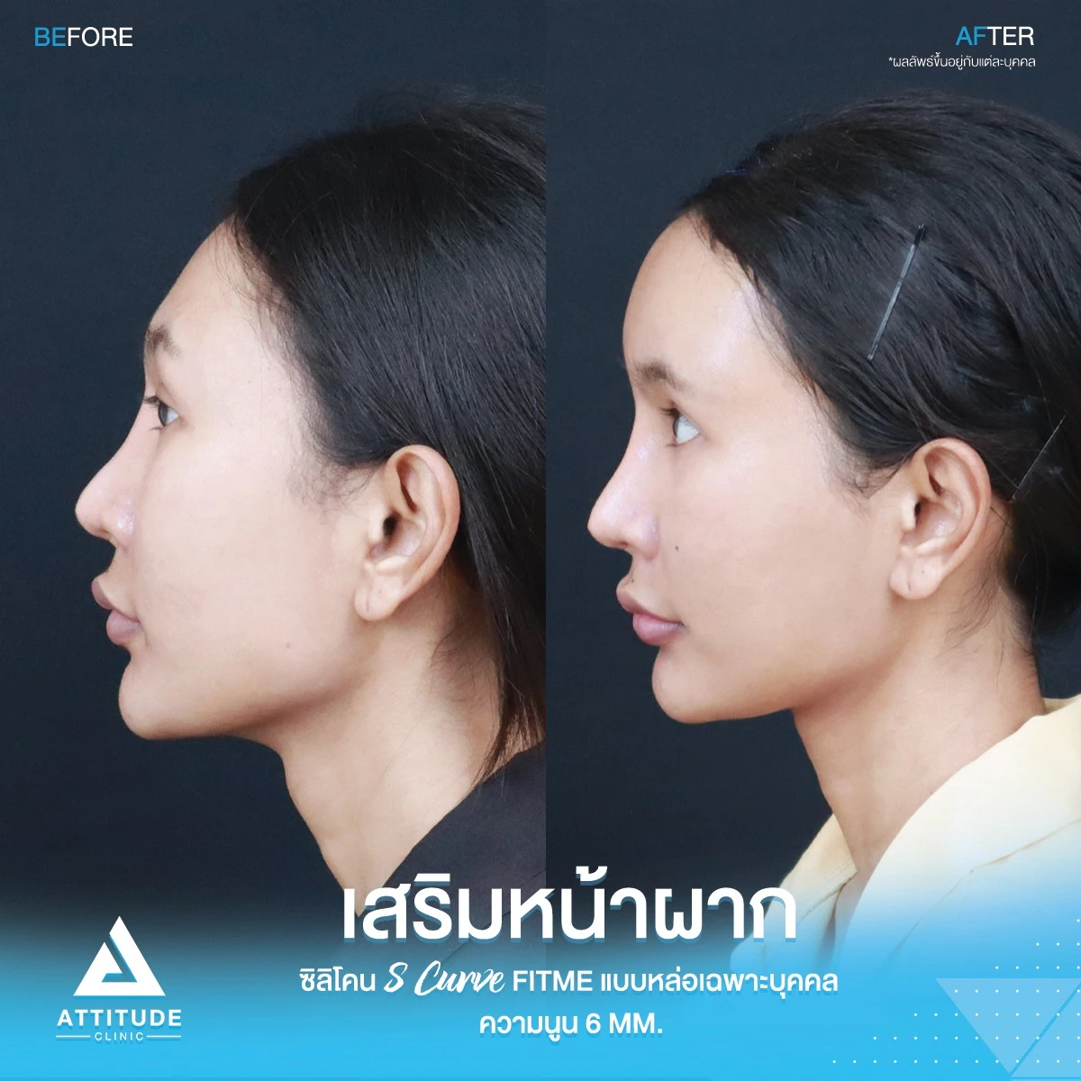 เสริมหน้าผาก