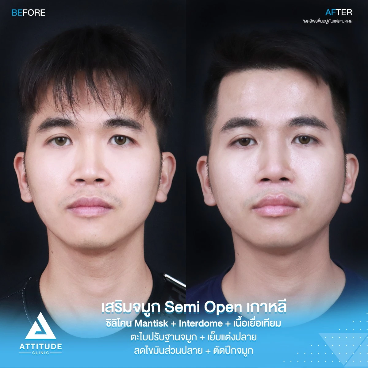 เสริมจมูก