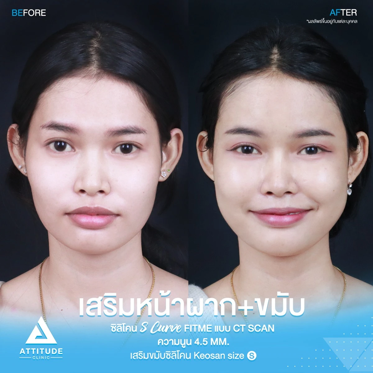 เสริมหน้าผาก เสริมขมับ