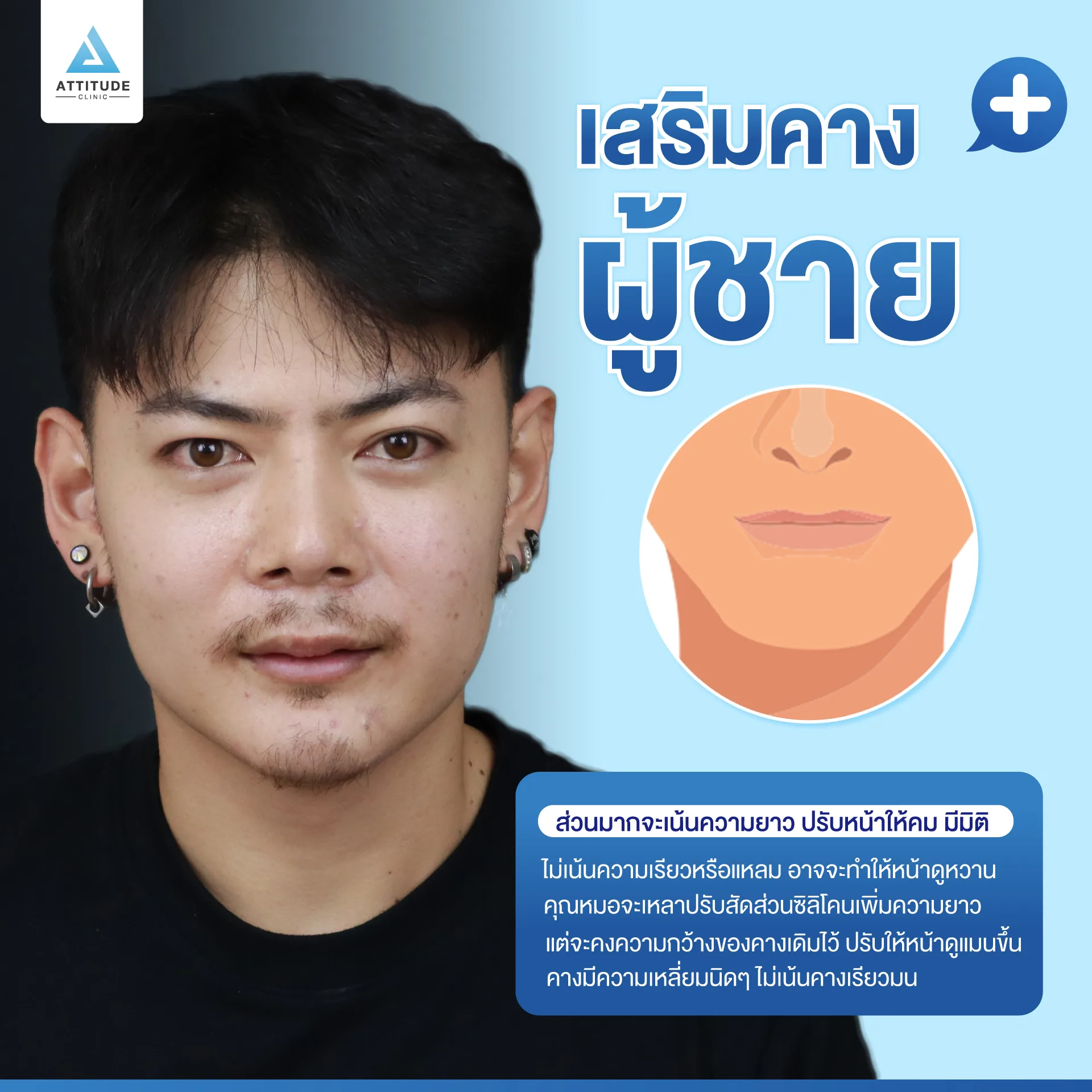 เสริมคาง