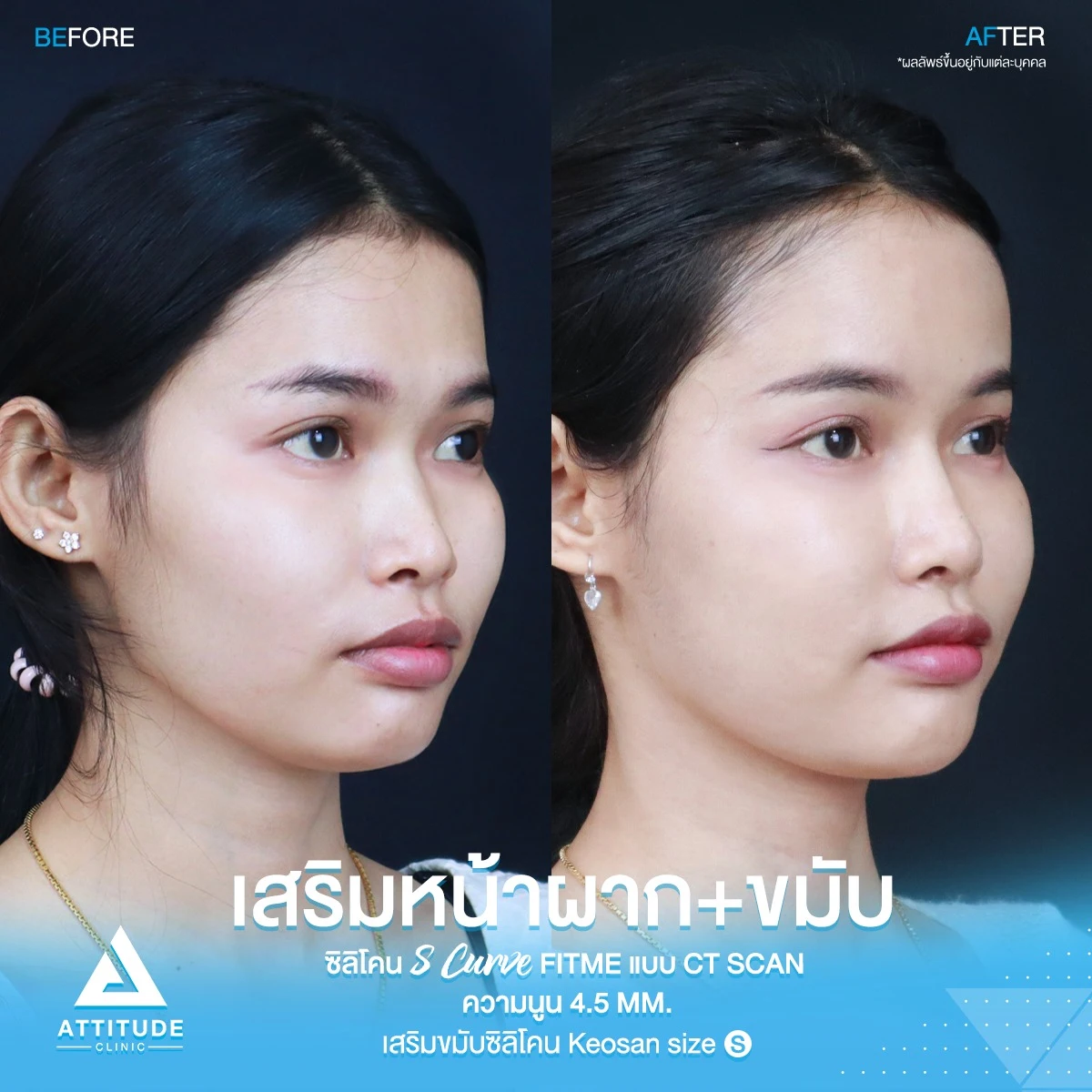 เสริมหน้าผาก เสริมขมับ