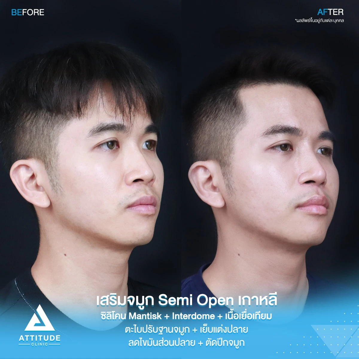เสริมจมูก