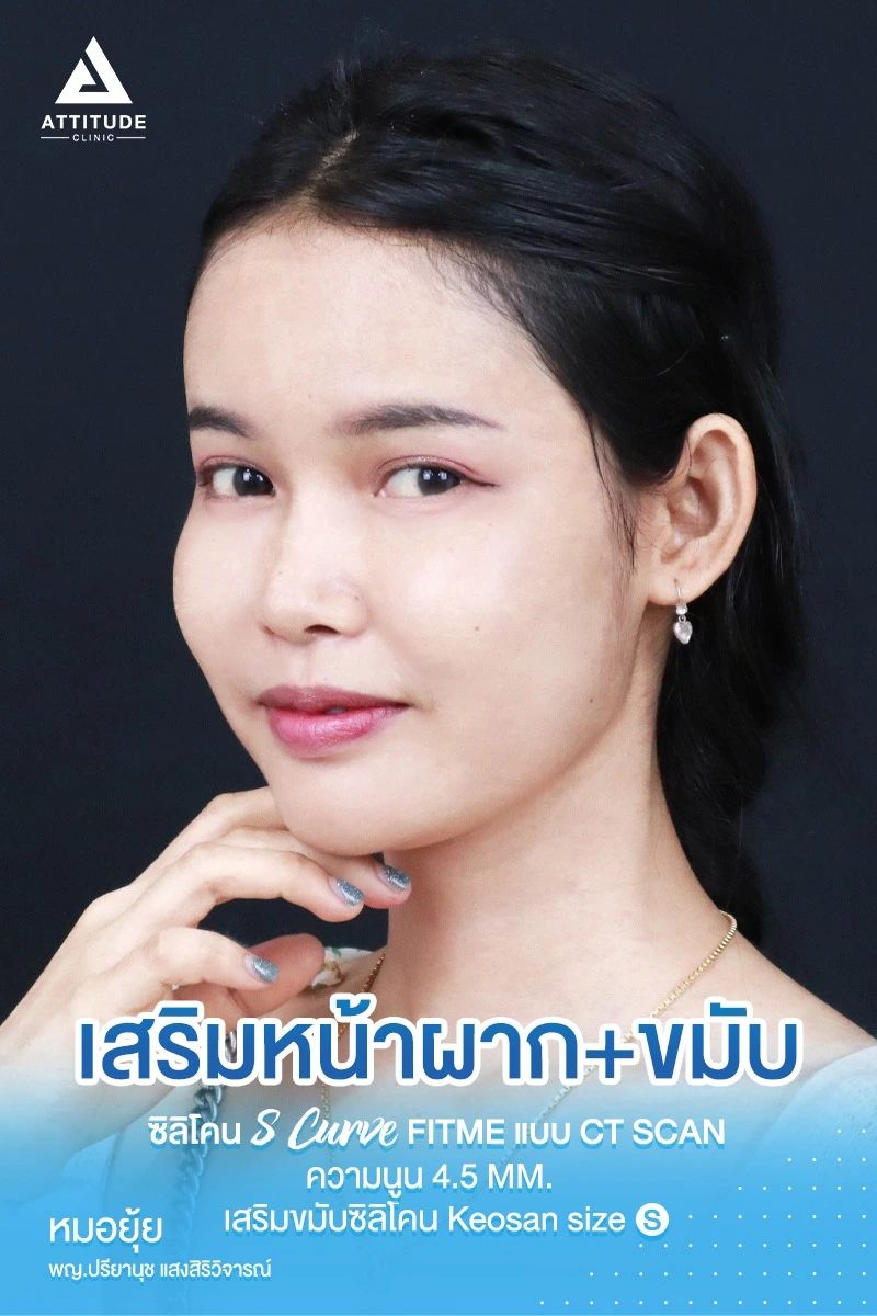 เสริมหน้าผาก เสริมขมับ