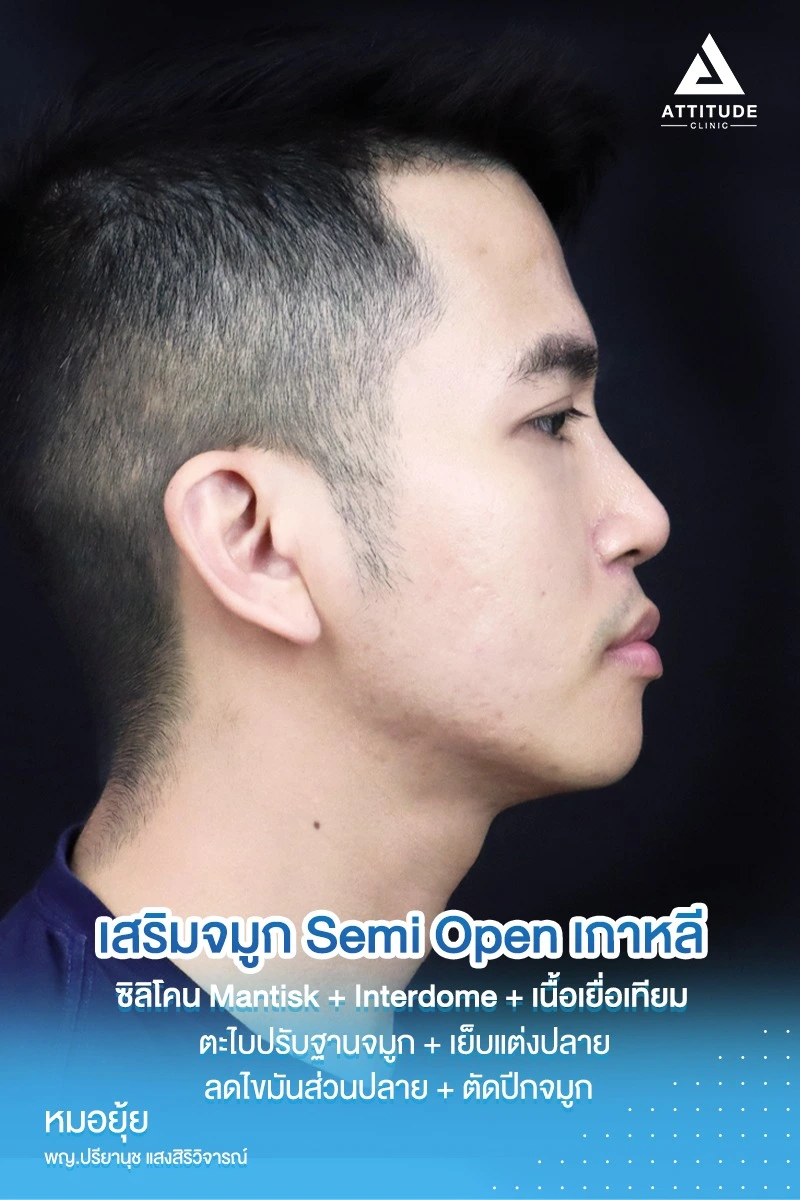 เสริมจมูก