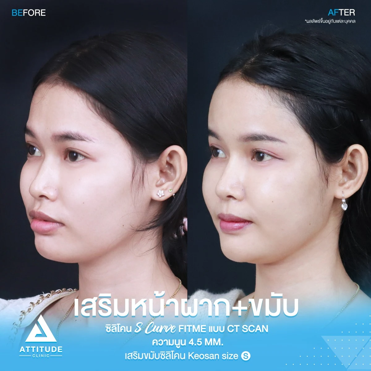 เสริมหน้าผาก เสริมขมับ