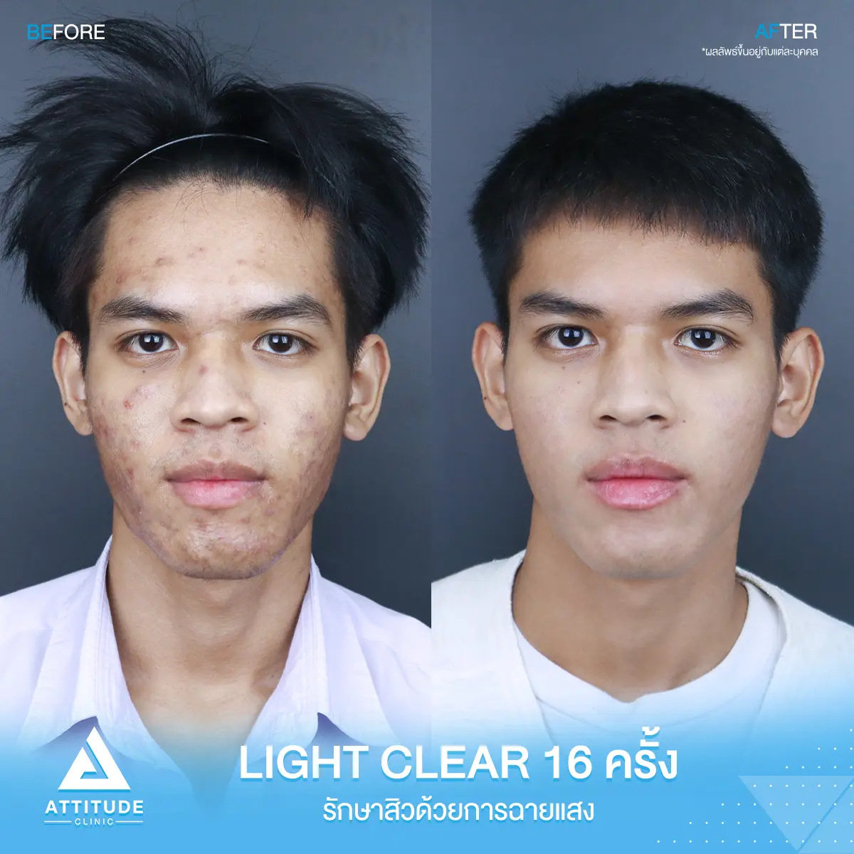 รีวิวรักษาสิว ด้วยการฉายแสง Light Clear 7 ขั้นตอน จำนวน 16 ครั้ง ของน้องอภิชาติ ที่มีปัญหาสิว และรอยสิว หลังรักษาครบคอร์สตอนนี้หน้าใส มั่นใจขึ้นสุดๆ