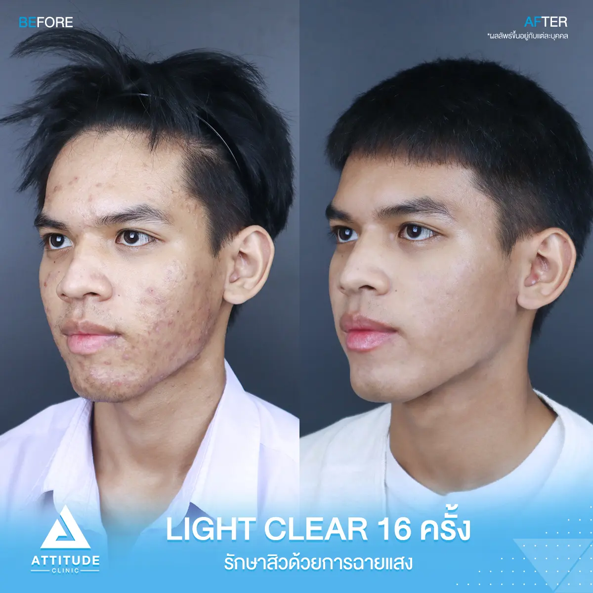 รีวิวรักษาสิว ด้วยการฉายแสง Light Clear 7 ขั้นตอน จำนวน 16 ครั้ง ของน้องอภิชาติ ที่มีปัญหาสิว และรอยสิว หลังรักษาครบคอร์สตอนนี้หน้าใส มั่นใจขึ้นสุดๆ