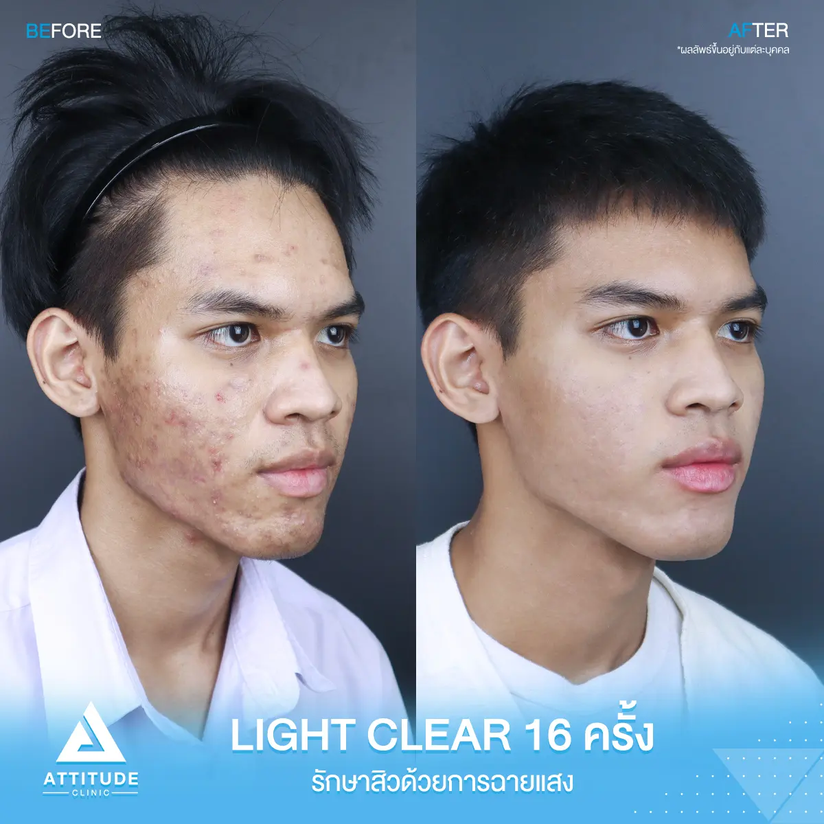 รีวิวรักษาสิว ด้วยการฉายแสง Light Clear 7 ขั้นตอน จำนวน 16 ครั้ง ของน้องอภิชาติ ที่มีปัญหาสิว และรอยสิว หลังรักษาครบคอร์สตอนนี้หน้าใส มั่นใจขึ้นสุดๆ