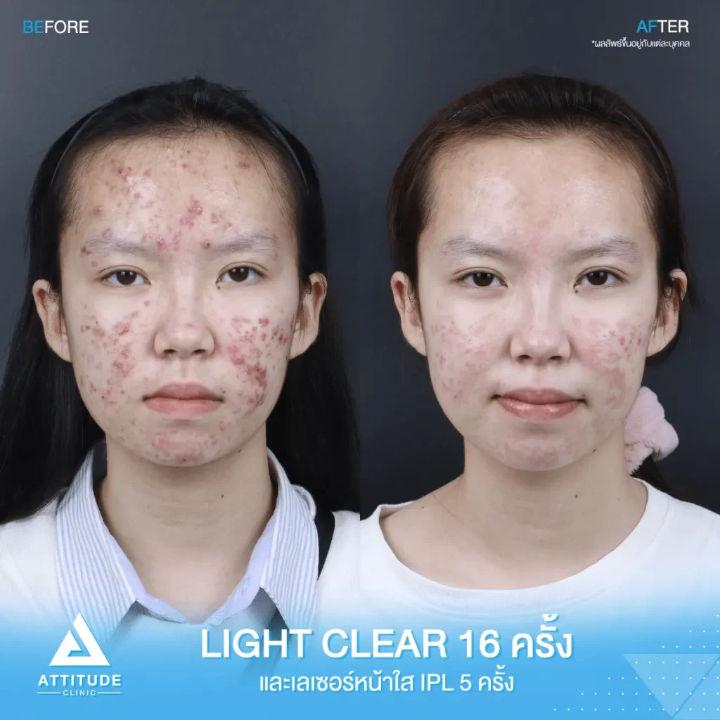 รีวิวรักษาสิว ด้วยการฉายแสง Light Clear 7 ขั้นตอน จำนวน 16 ครั้ง และเลเซอร์หน้าใส ลดรอยสิว Cellec V IPL จำนวน 5 ครั้ง ของคุณจูน ที่มีปัญหาสิว และรอยสิว