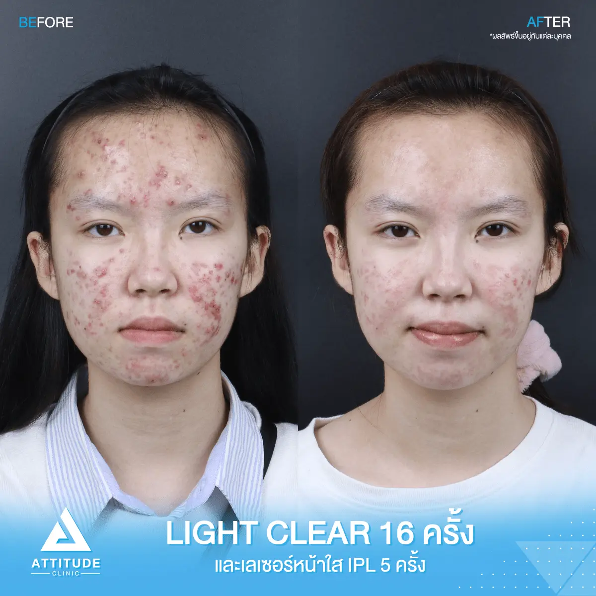 รีวิวรักษาสิว ด้วยการฉายแสง Light Clear 7 ขั้นตอน จำนวน 16 ครั้ง และเลเซอร์หน้าใส ลดรอยสิว Cellec V IPL จำนวน 5 ครั้ง ของคุณจูน ที่มีปัญหาสิว และรอยสิว