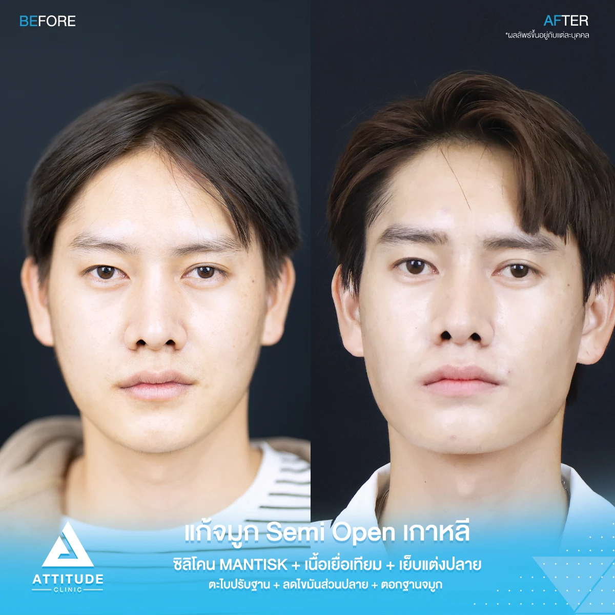 เสริมจมูก