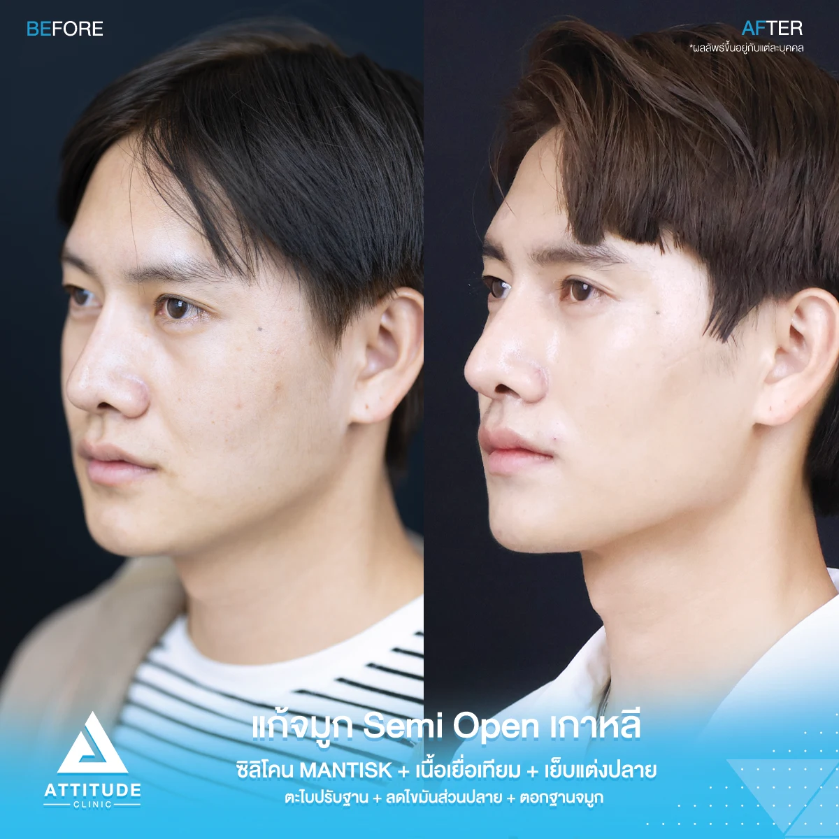 เสริมจมูก
