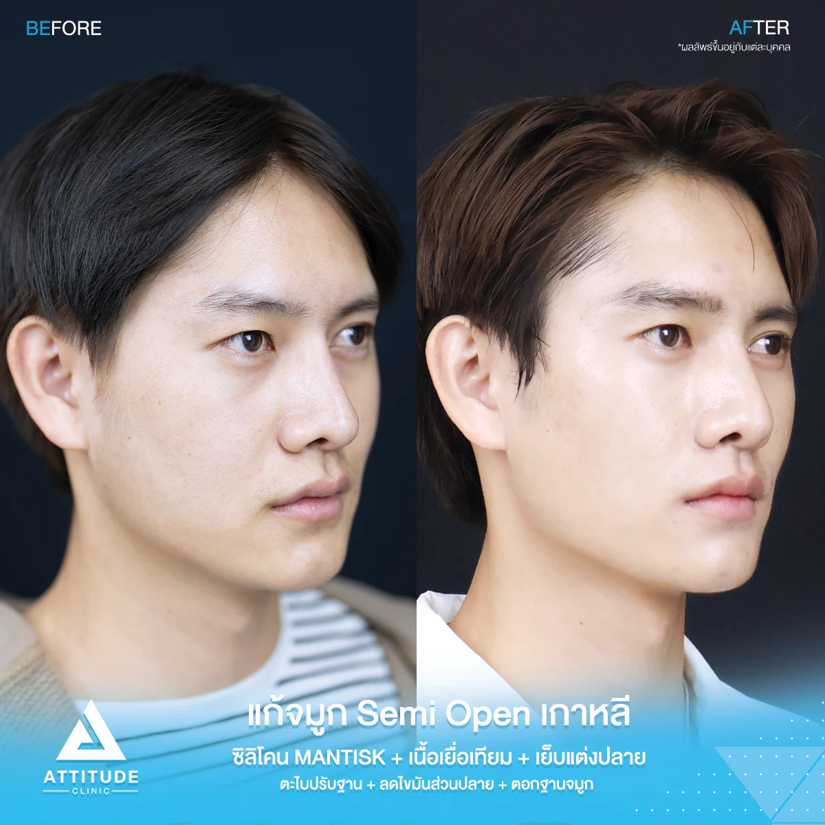 เสริมจมูก