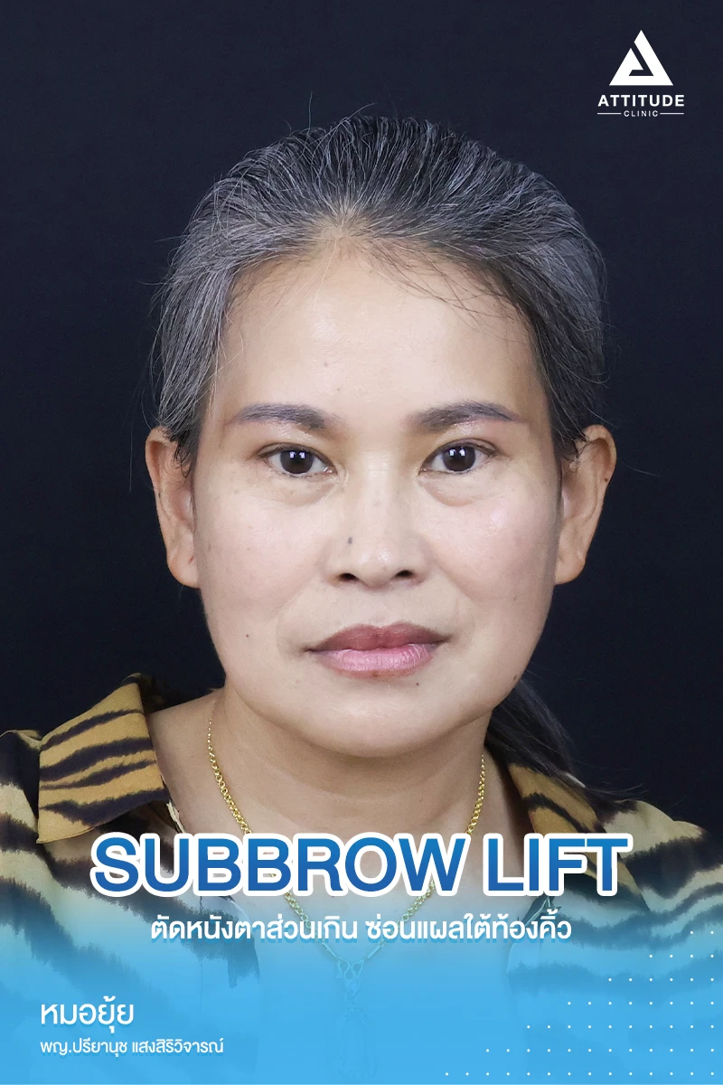 Subbrowlift