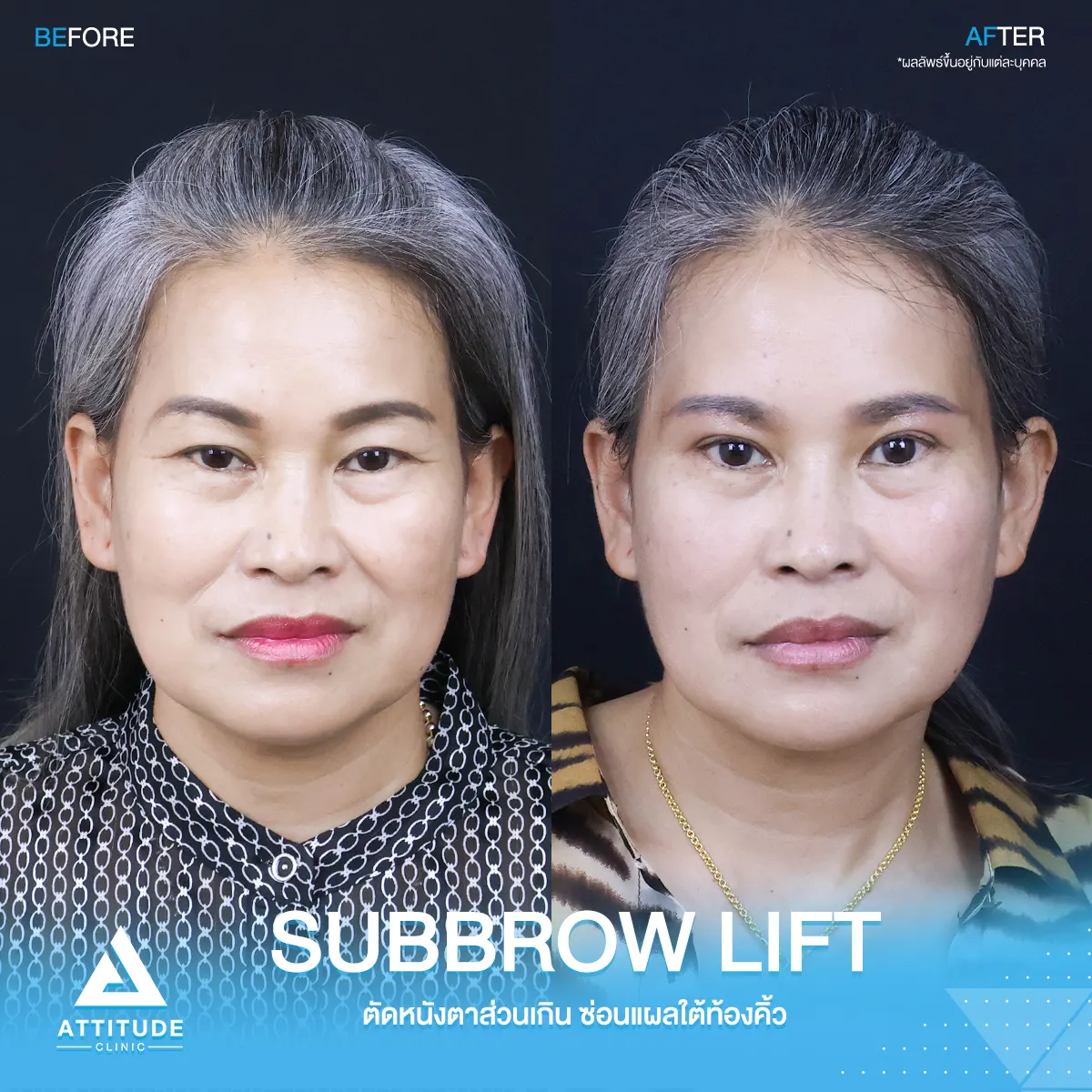 Subbrowlift