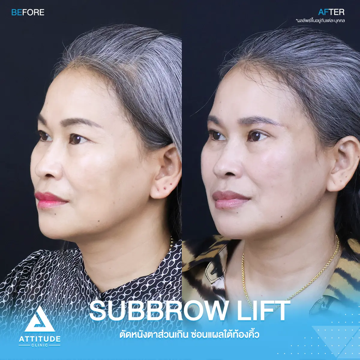 Subbrowlift