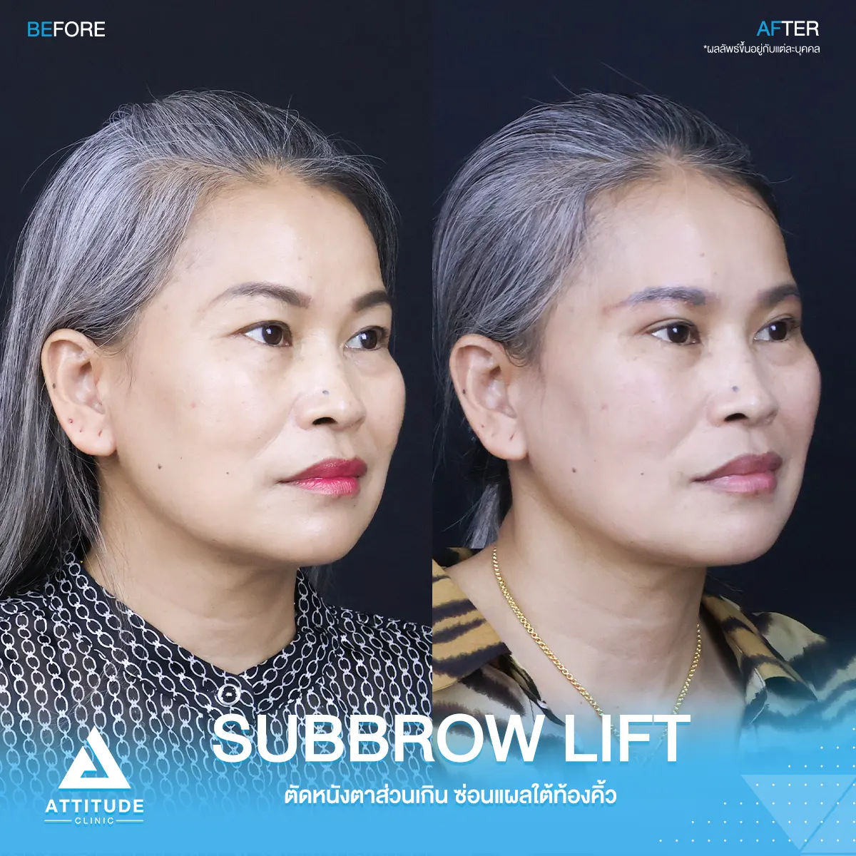 Subbrowlift