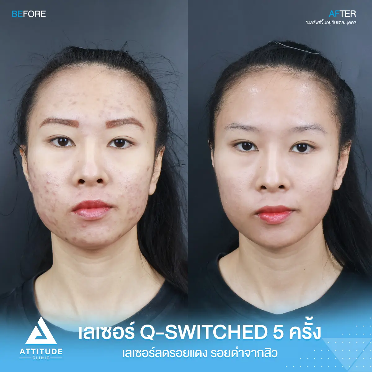 รีวิวเลเซอร์ยิงลดเม็ดสี Q-switched 5 ครั้ง ของคุณบีม ปรับผิวเรียบเนียน ลดรอยสิว เพิ่มความมั่นใจที่ Attitude Clinic