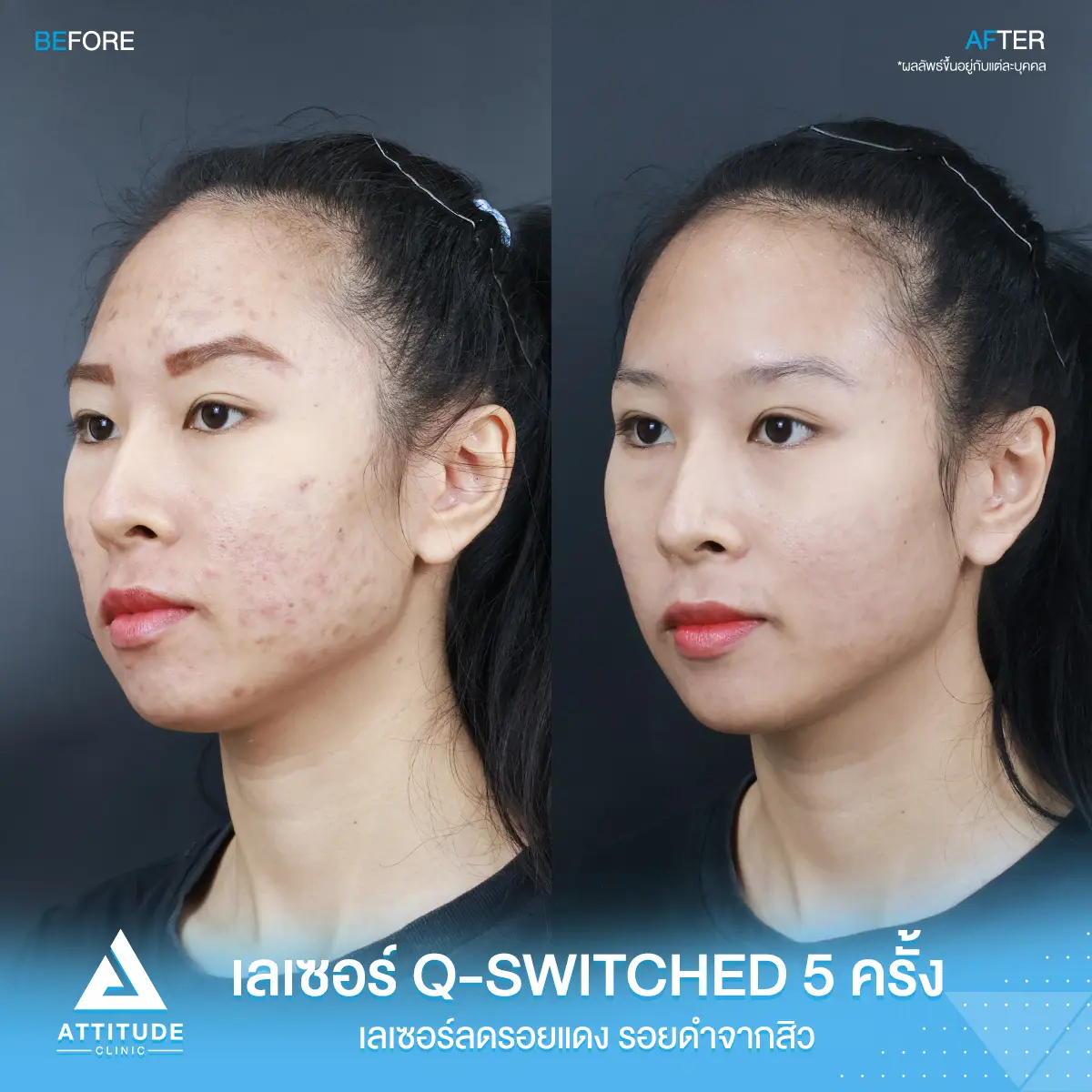 รีวิวเลเซอร์ยิงลดเม็ดสี Q-switched 5 ครั้ง ของคุณบีม ปรับผิวเรียบเนียน ลดรอยสิว เพิ่มความมั่นใจที่ Attitude Clinic