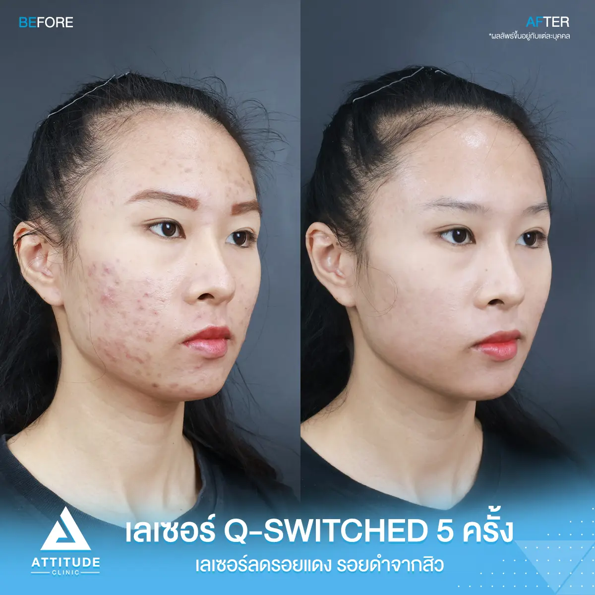 รีวิวเลเซอร์ยิงลดเม็ดสี Q-switched 5 ครั้ง ของคุณบีม ปรับผิวเรียบเนียน ลดรอยสิว เพิ่มความมั่นใจที่ Attitude Clinic