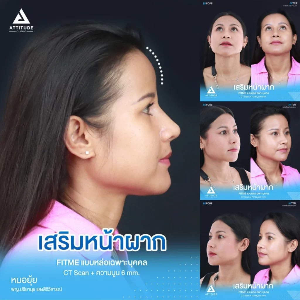 เสริมหน้าผาก