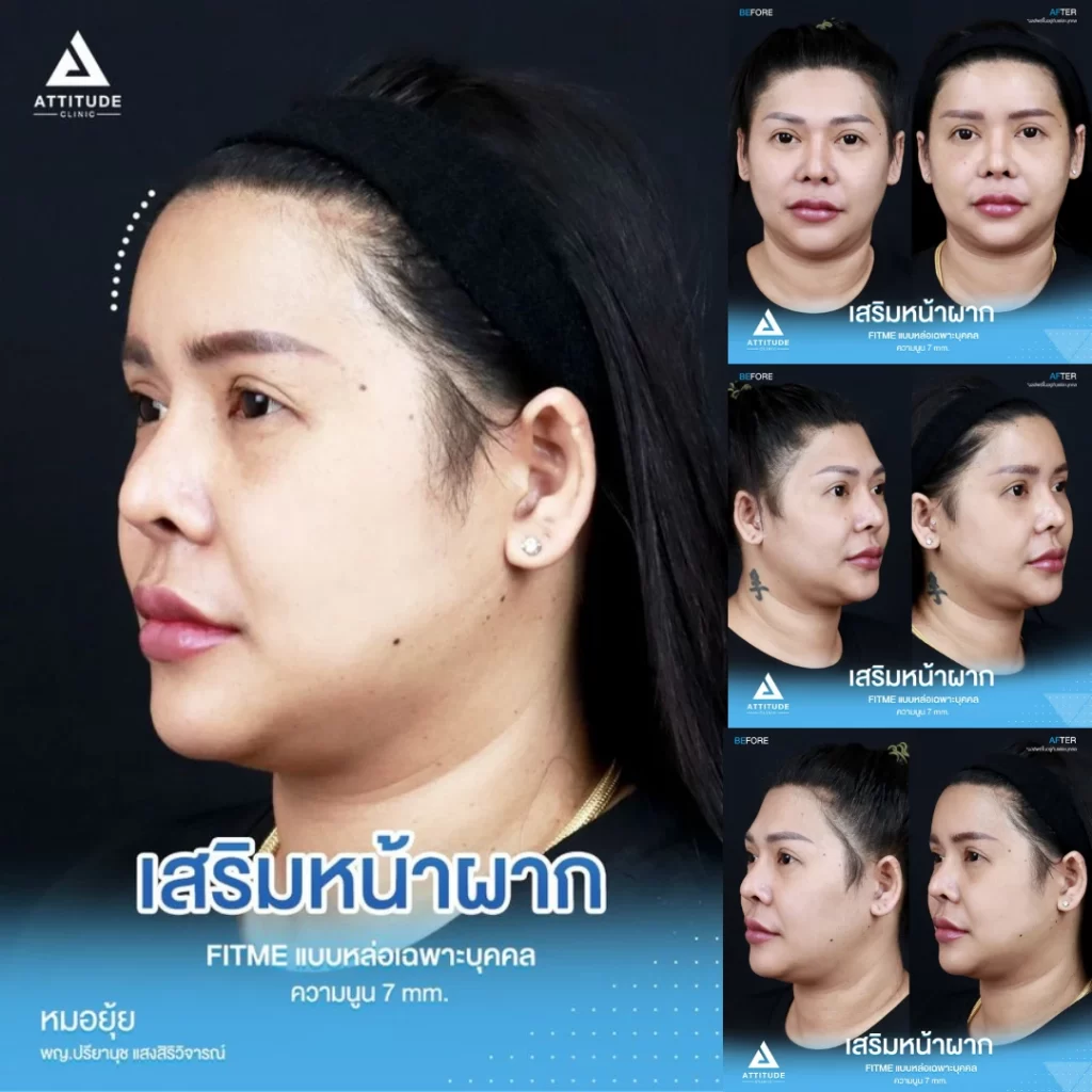 เสริมหน้าผาก