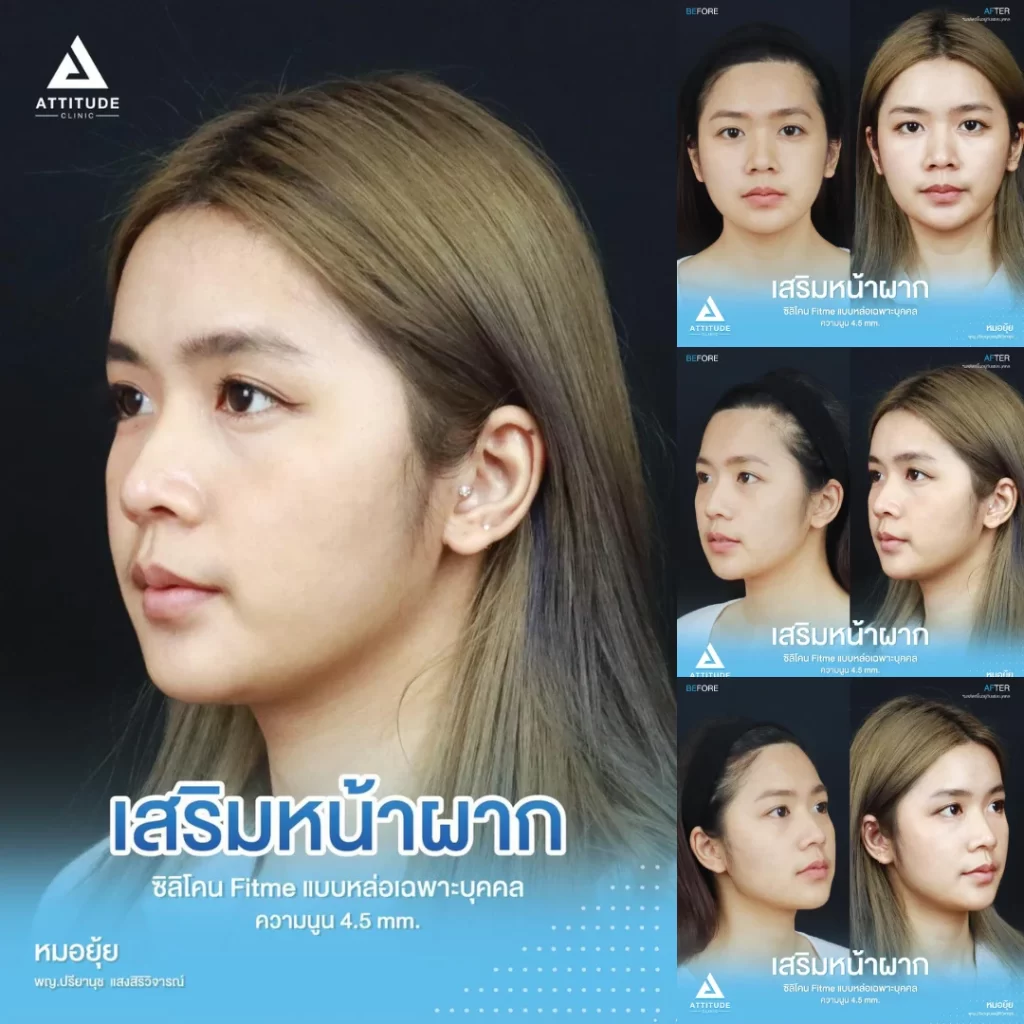คลิก >> ดูรีวิวเสริมหน้าผากเพิ่มเติม