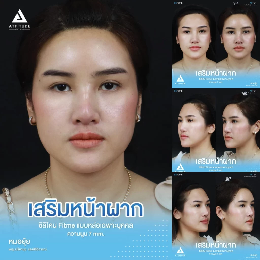 เสริมหน้าผาก