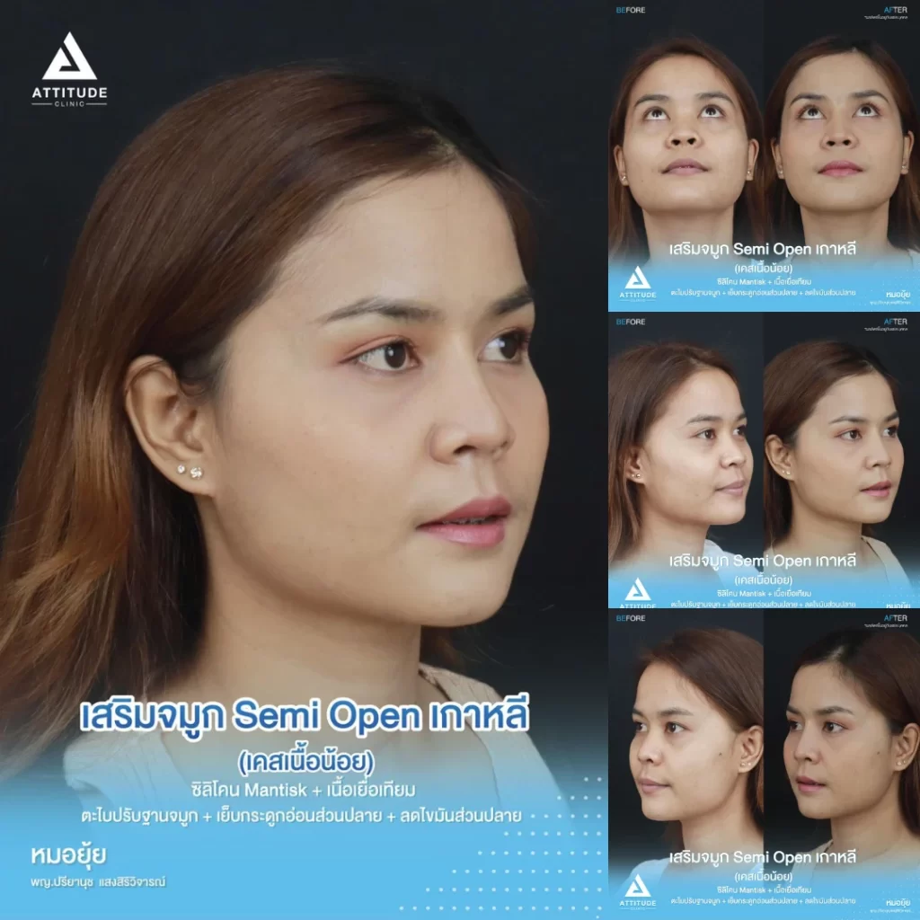เสริมจมูก