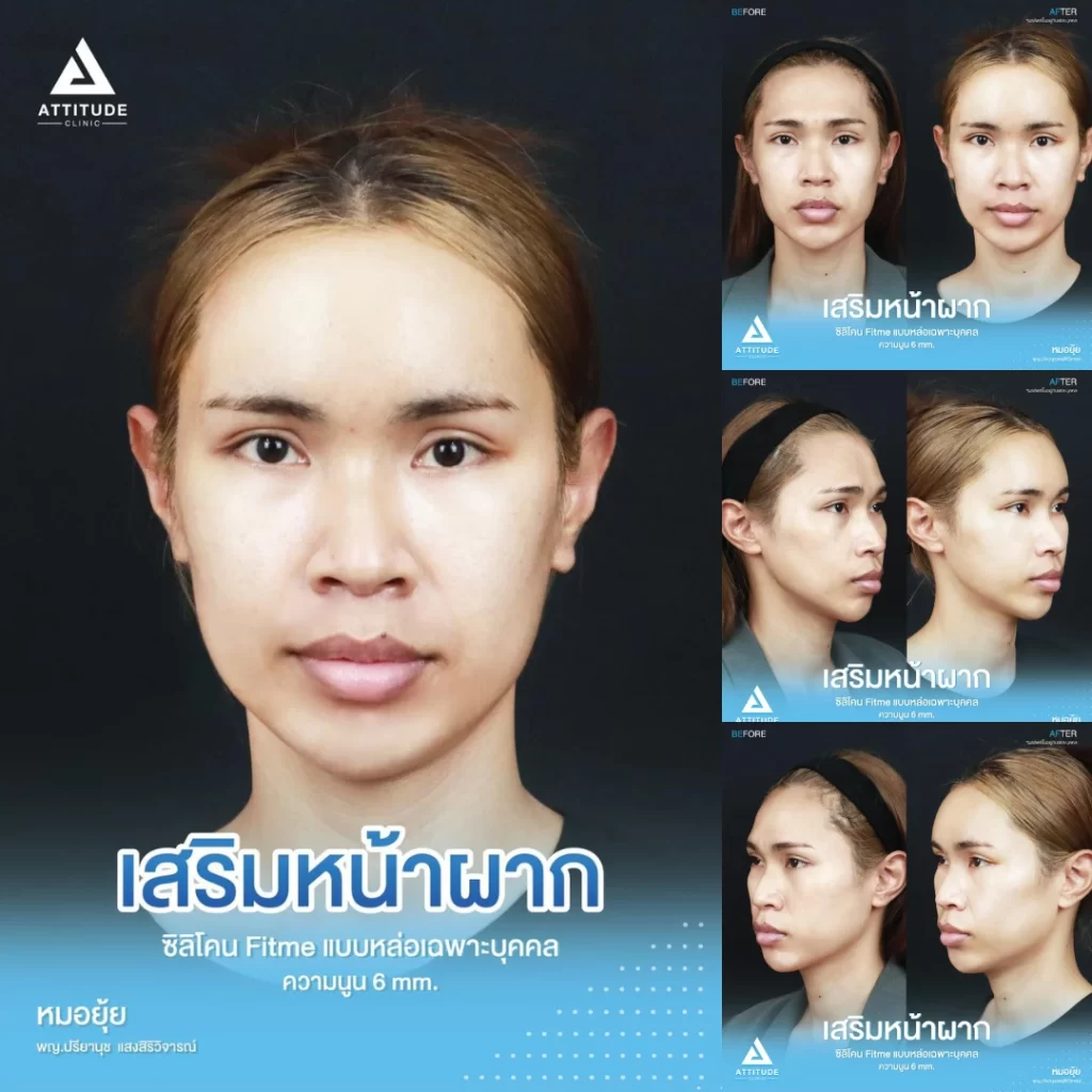 เสริมหน้าผาก