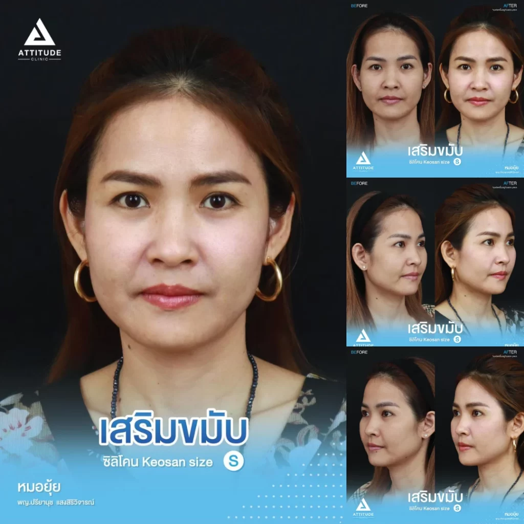 เสริมขมับ