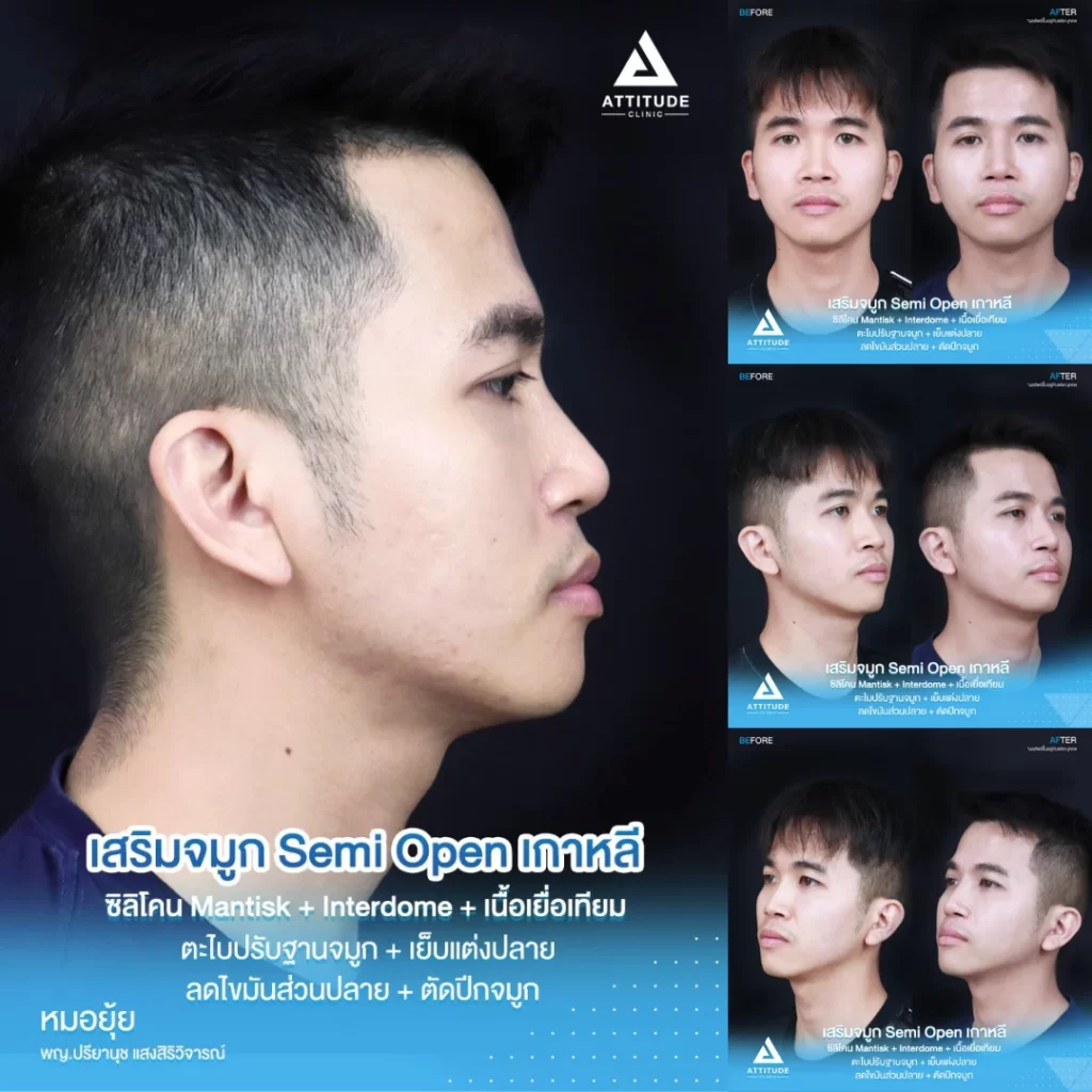เสริมจมูก