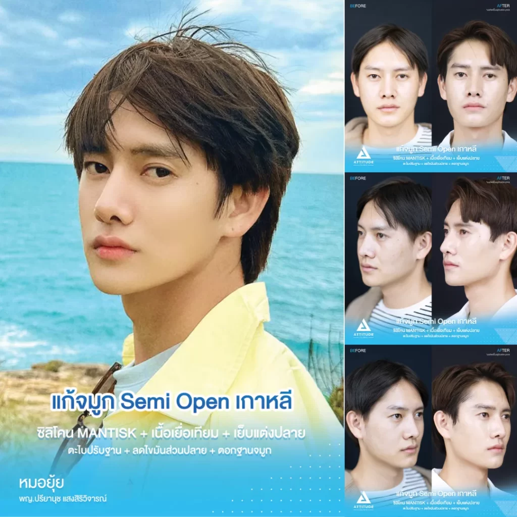 เสริมจมูก