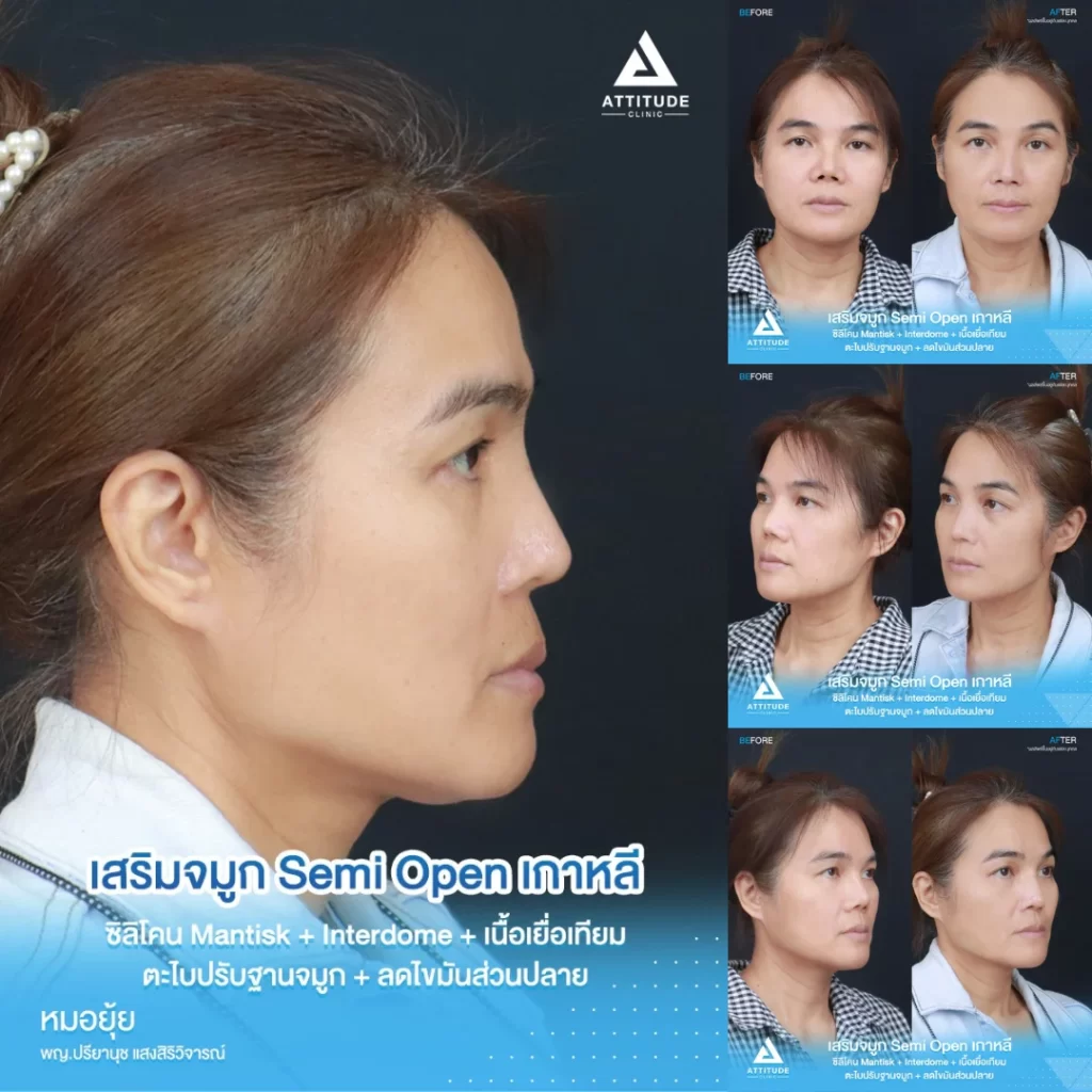 เสริมจมูก