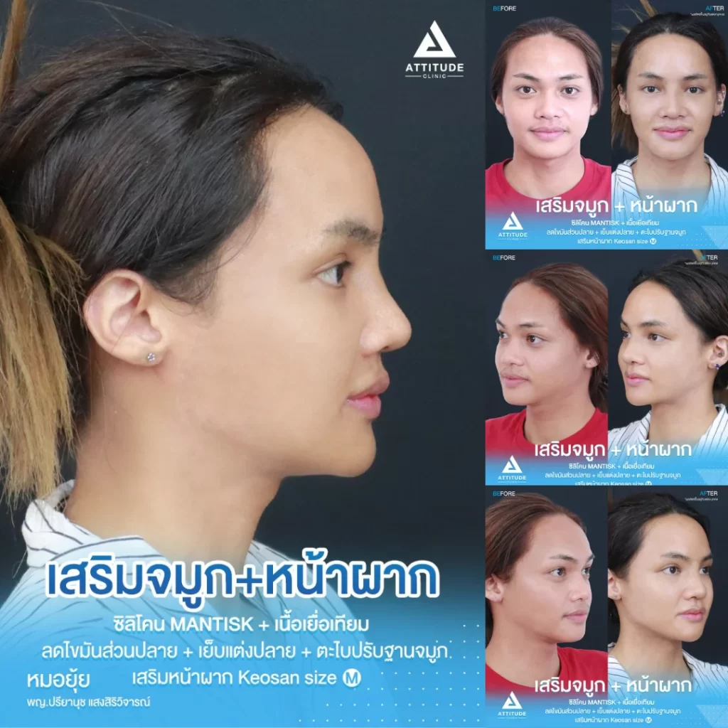 เสริมจมูก เสริมหน้าผาก