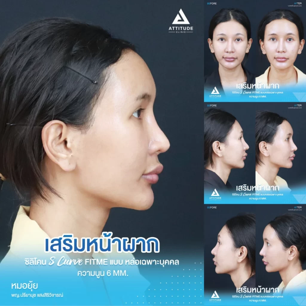 เสริมหน้าผาก