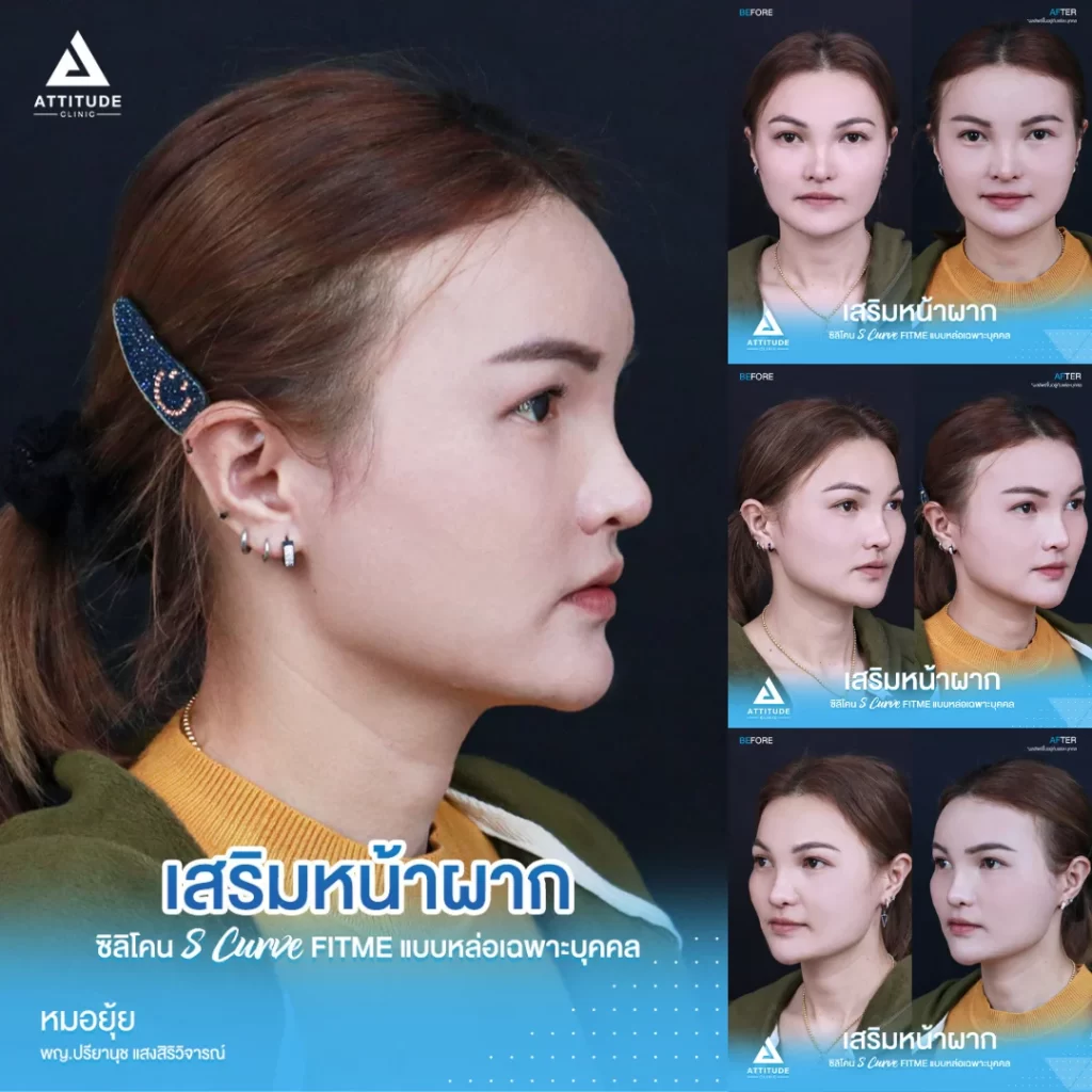 เสริมหน้าผาก