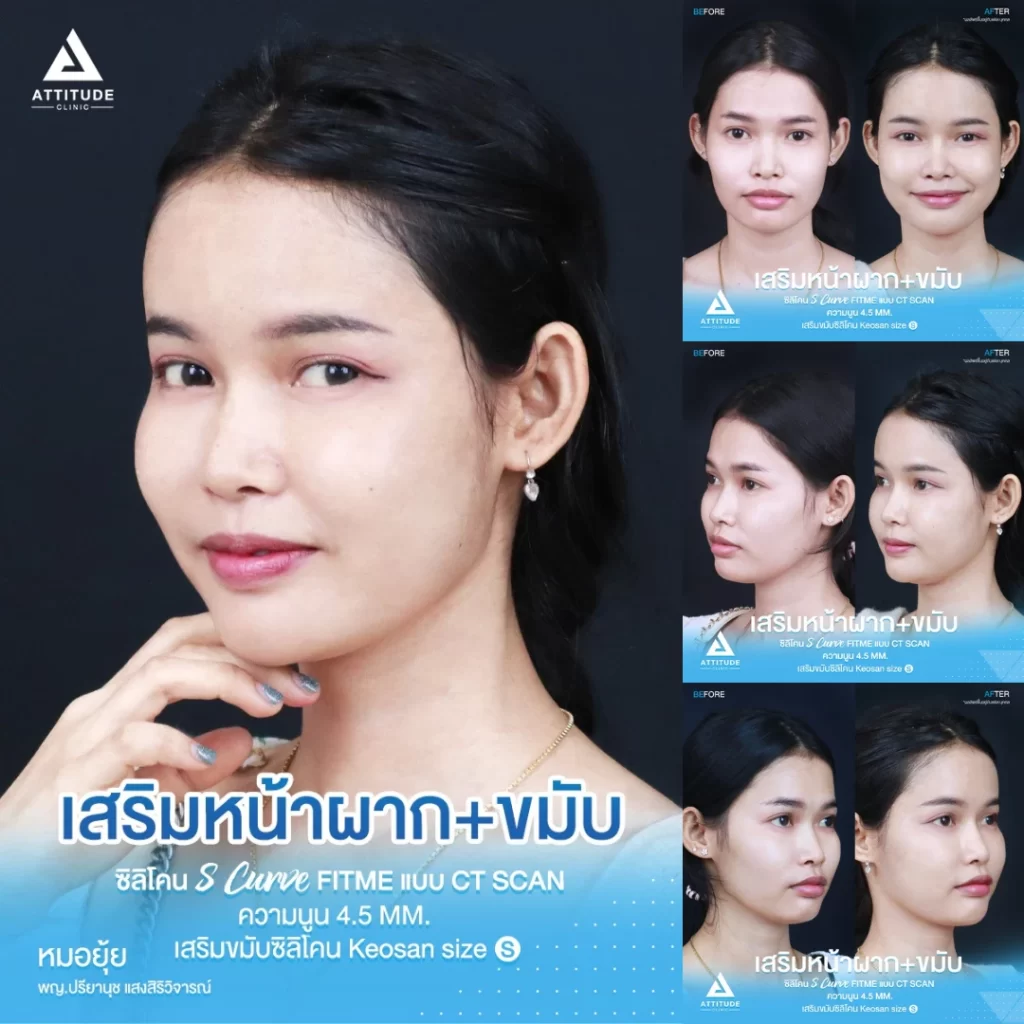 เสริมหน้าผาก เสริมขมับ