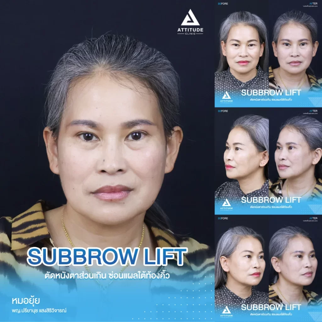 Subbrowlift