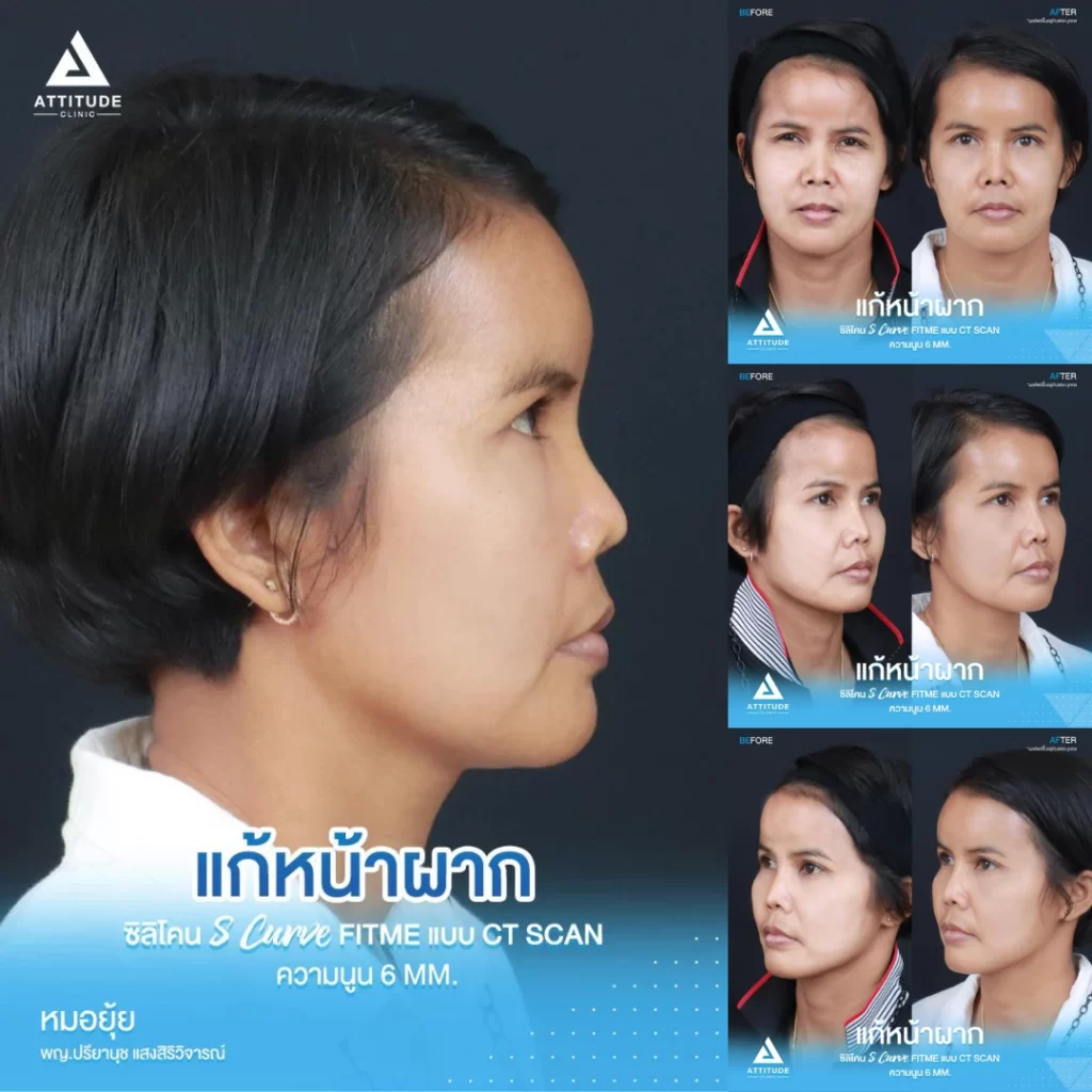 เสริมหน้าผาก