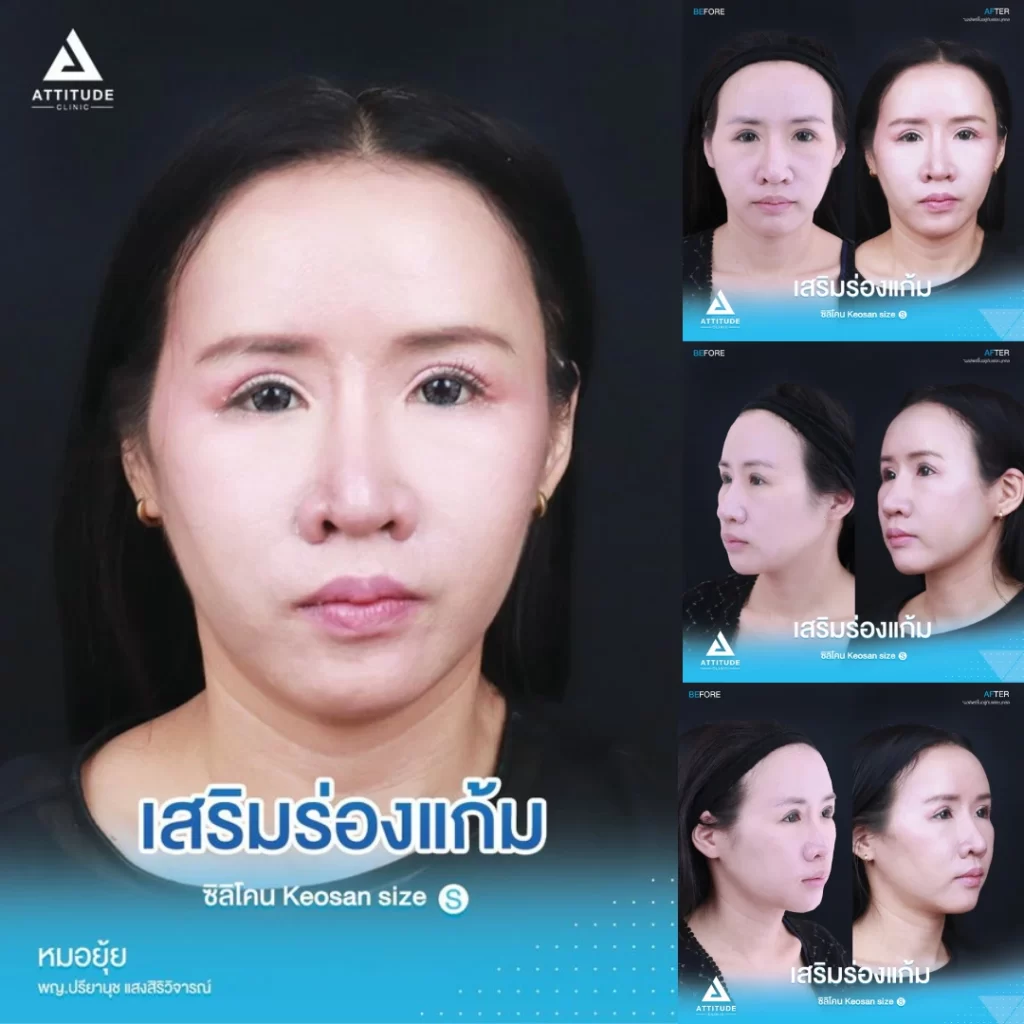 เสริมร่องแก้ม