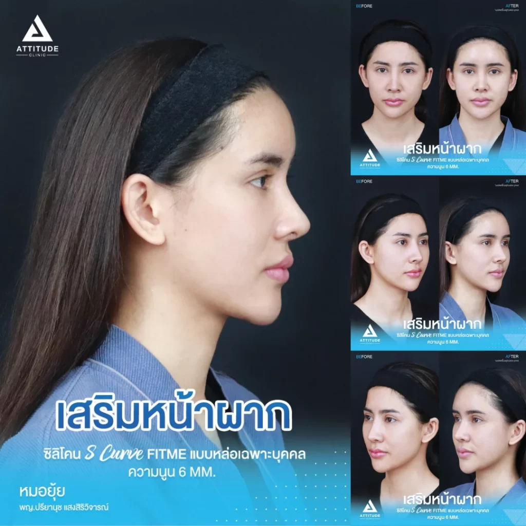 เสริมหน้าผาก