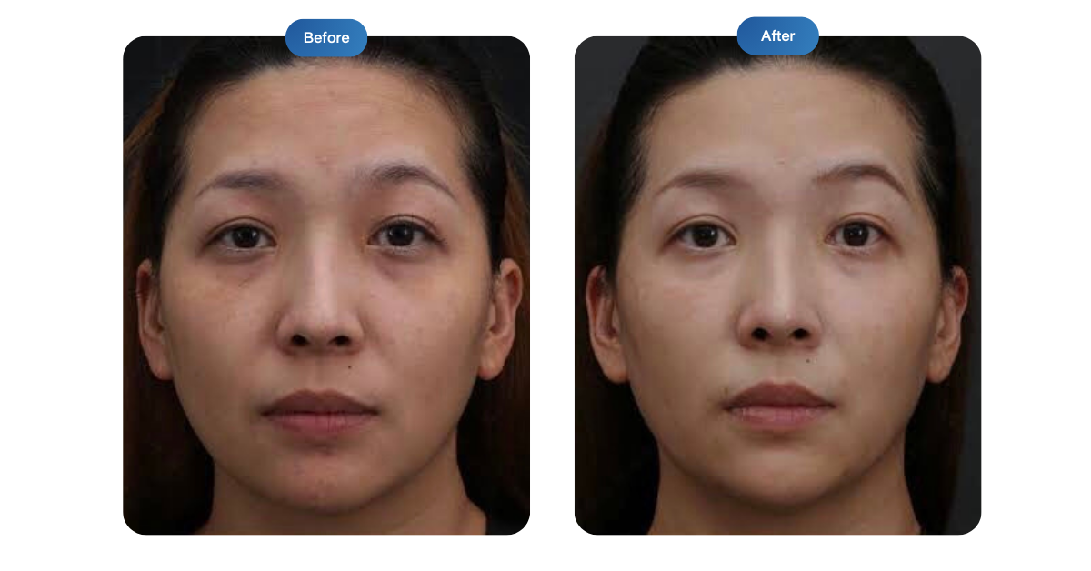 ข้อมูลครบ! ทำความรู้จัก AestheFill กระตุ้นคอลลาเจนด้วย PDLLA ตัวดังจากเกาหลี ช่วยให้ผิวกระชับ อิ่มฟู ลดริ้วรอย เติมเต็มร่องลึก ผิวเด็กยาวนาน 2 ปี AestheFill คืออะไร? ราคา AestheFill? AestheFill ดีมั้ย? ทำไมต้องฉีด AestheFill? AestheFill รีวิว? AestheFill เหมาะกับใคร?