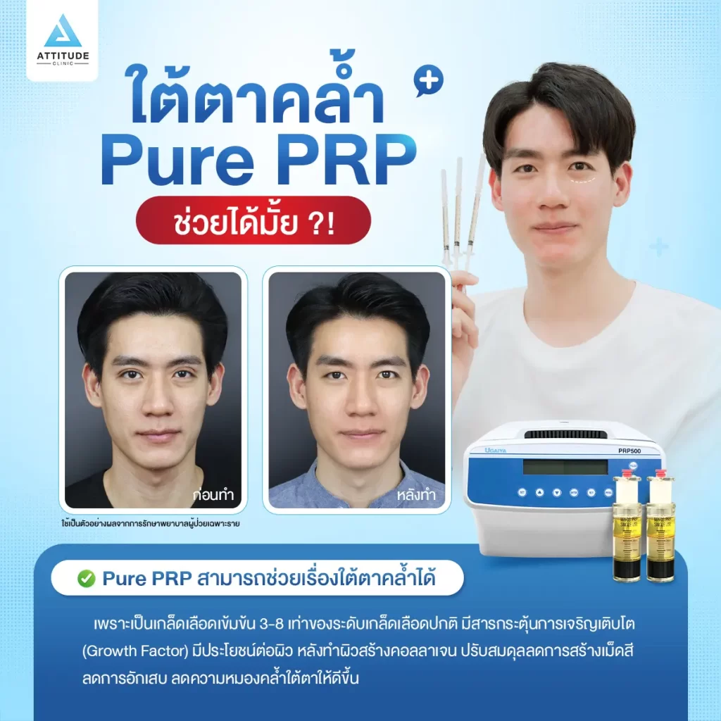 ใต้ตาคล้ำ Pure PRP ช่วยได้มั้ย?