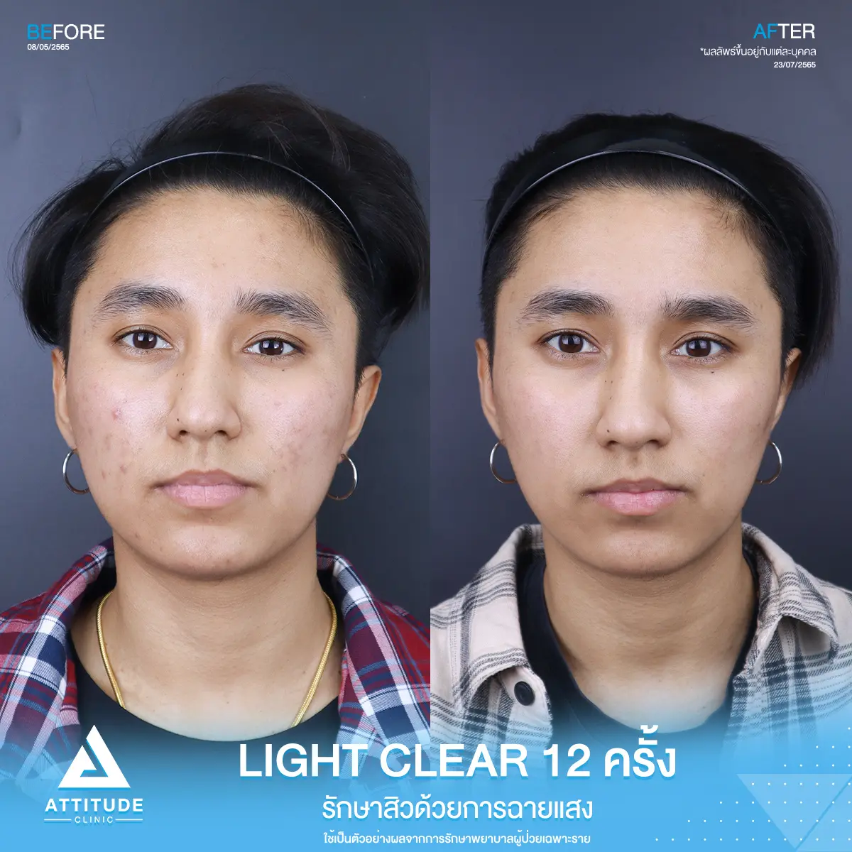 รีวิวรักษาสิว ด้วยการฉายแสง Light Clear 7 ขั้นตอน จำนวน 12 ครั้ง ของคุณสุภัทร์ ที่มีปัญหาสิว และรอยสิว