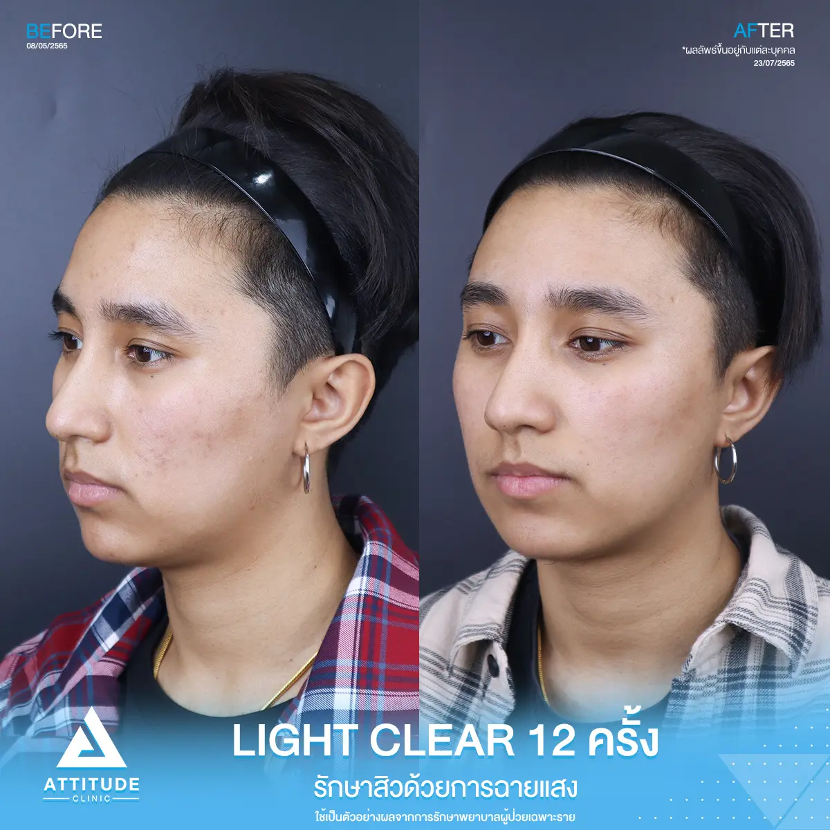 รีวิวรักษาสิว ด้วยการฉายแสง Light Clear 7 ขั้นตอน จำนวน 12 ครั้ง ของคุณสุภัทร์ ที่มีปัญหาสิว และรอยสิว