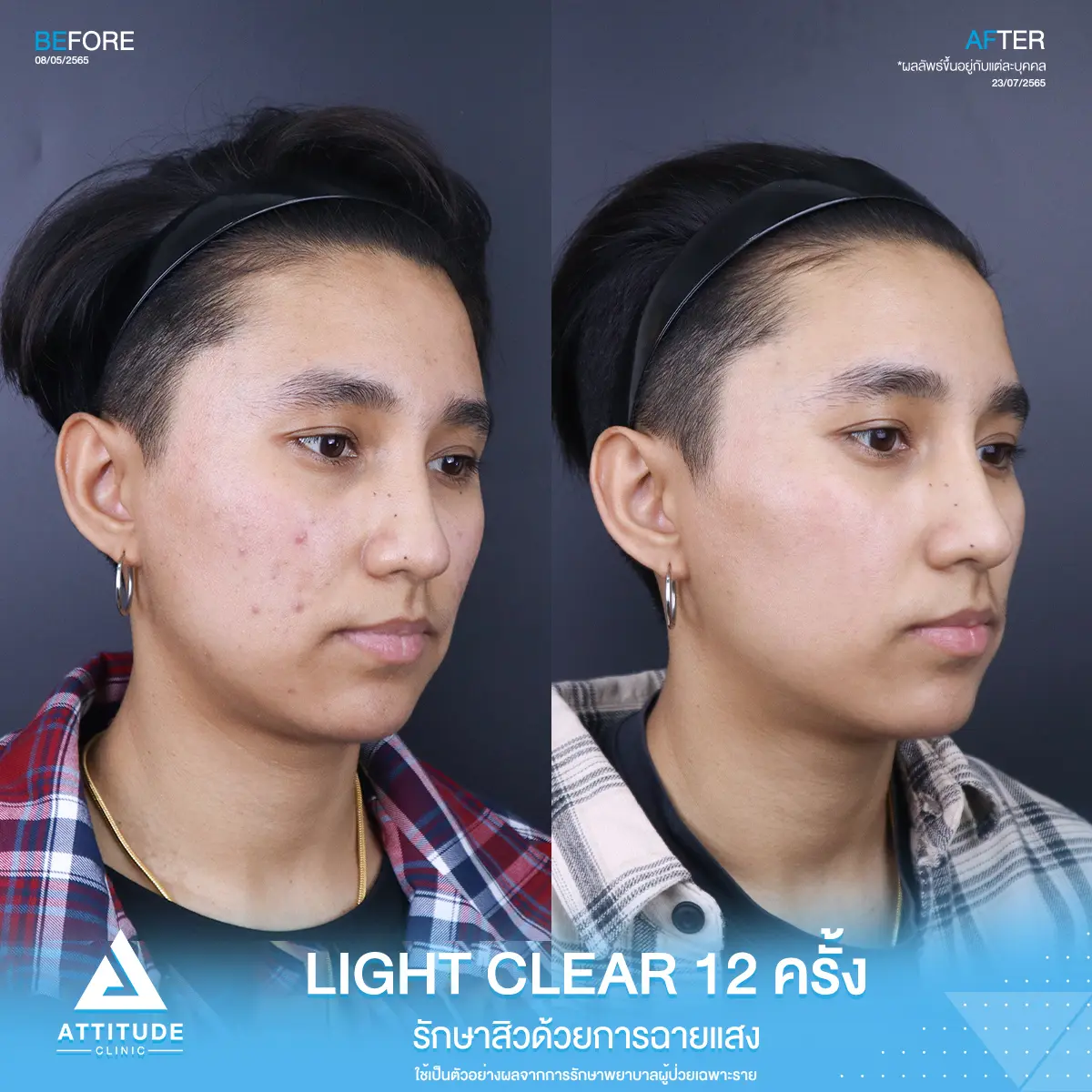 รีวิวรักษาสิว ด้วยการฉายแสง Light Clear 7 ขั้นตอน จำนวน 12 ครั้ง ของคุณสุภัทร์ ที่มีปัญหาสิว และรอยสิว