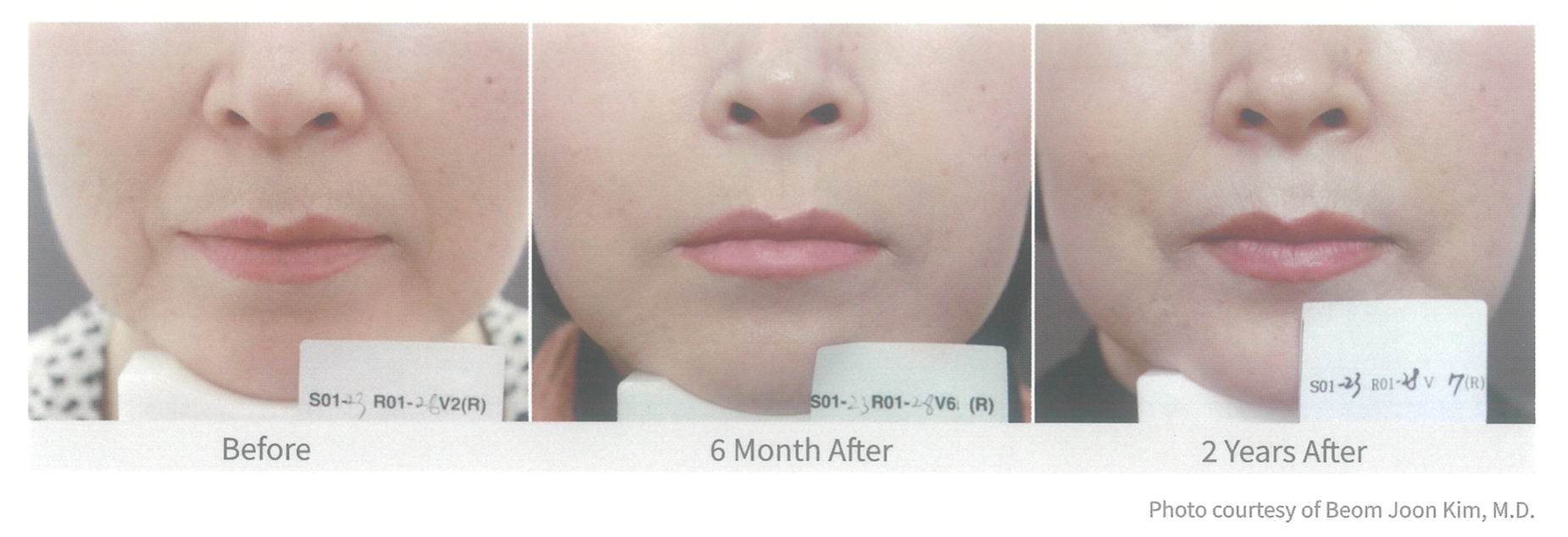รีวิว AestheFill รีวิว ข้อมูลครบ! ทำความรู้จัก AestheFill กระตุ้นคอลลาเจนด้วย PDLLA ตัวดังจากเกาหลี ช่วยให้ผิวกระชับ อิ่มฟู ลดริ้วรอย เติมเต็มร่องลึก ผิวเด็กยาวนาน 2 ปี AestheFill คืออะไร? ราคา AestheFill? AestheFill ดีมั้ย? ทำไมต้องฉีด AestheFill? AestheFill รีวิว? AestheFill เหมาะกับใคร?