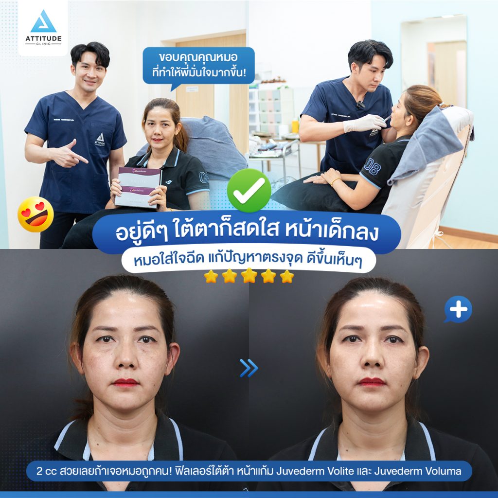 ปัญหาใต้ตาลึก ถุงใต้ตา ทำให้หน้าดูมีอายุ แก้ได้แค่เติมฟิลเลอร์! ไม่ต้องใช้เวลานาน เห็นการเปลี่ยนแปลงได้เลย ดูแลโดยคุณหมอมากประสบการณ์ ฟิลเลอร์คุณภาพ ช่วยคุณได้